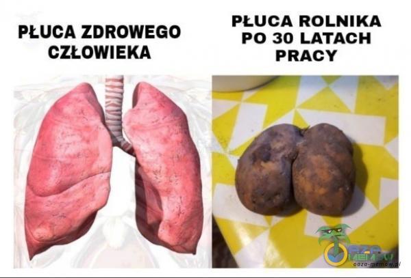 PŁUCA ROLNIKA PŁUCA ZDROWEGO PO 30 LATACH CZŁOWIEKA PRACY