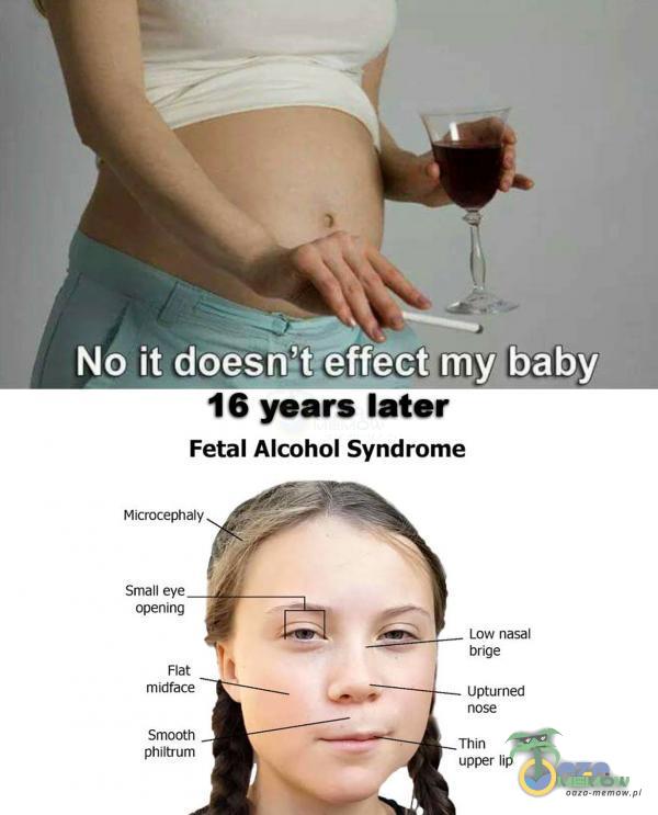 No ił doesn:teffect my baby 16 years later Fetal Alcohol Syndrome Microcephaly Small eye opening midface philtrum Low nasal brige Upturned upper lip