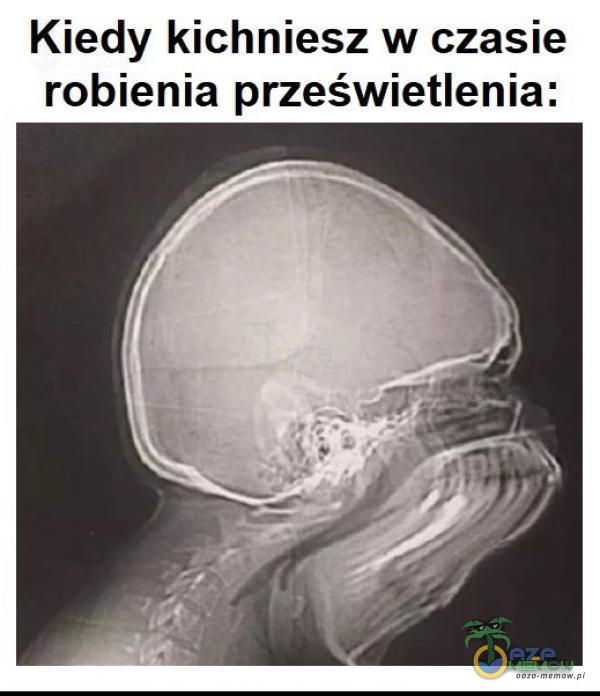 Kiedy kichniesz w czasie robienia prześwietlenia: